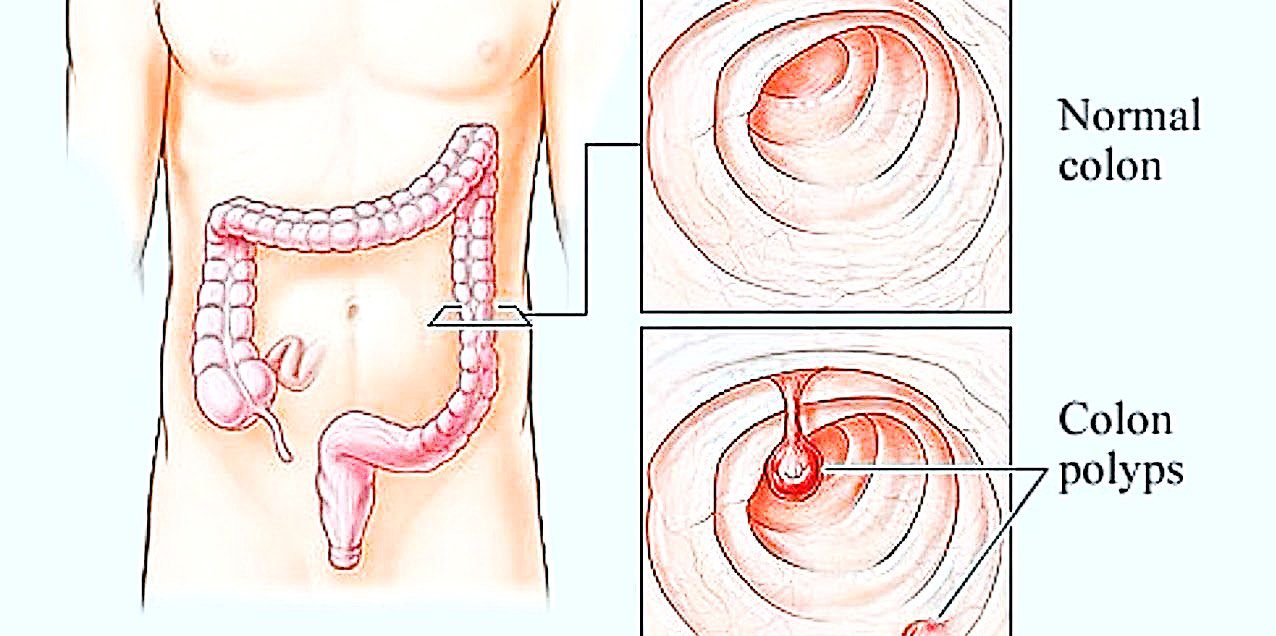 Colonic polypectomy procedure illustration