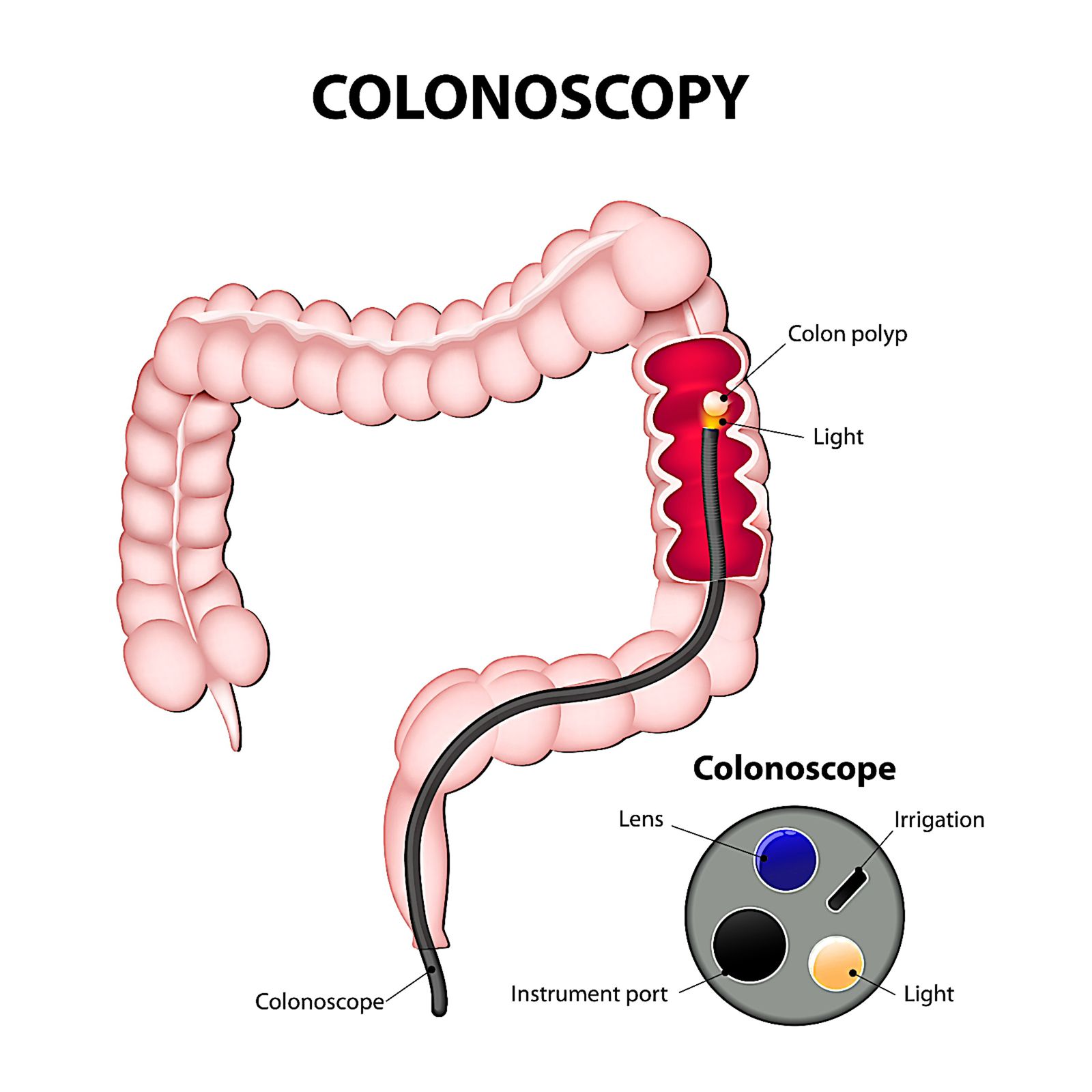 Colonoscopy procedure illustration