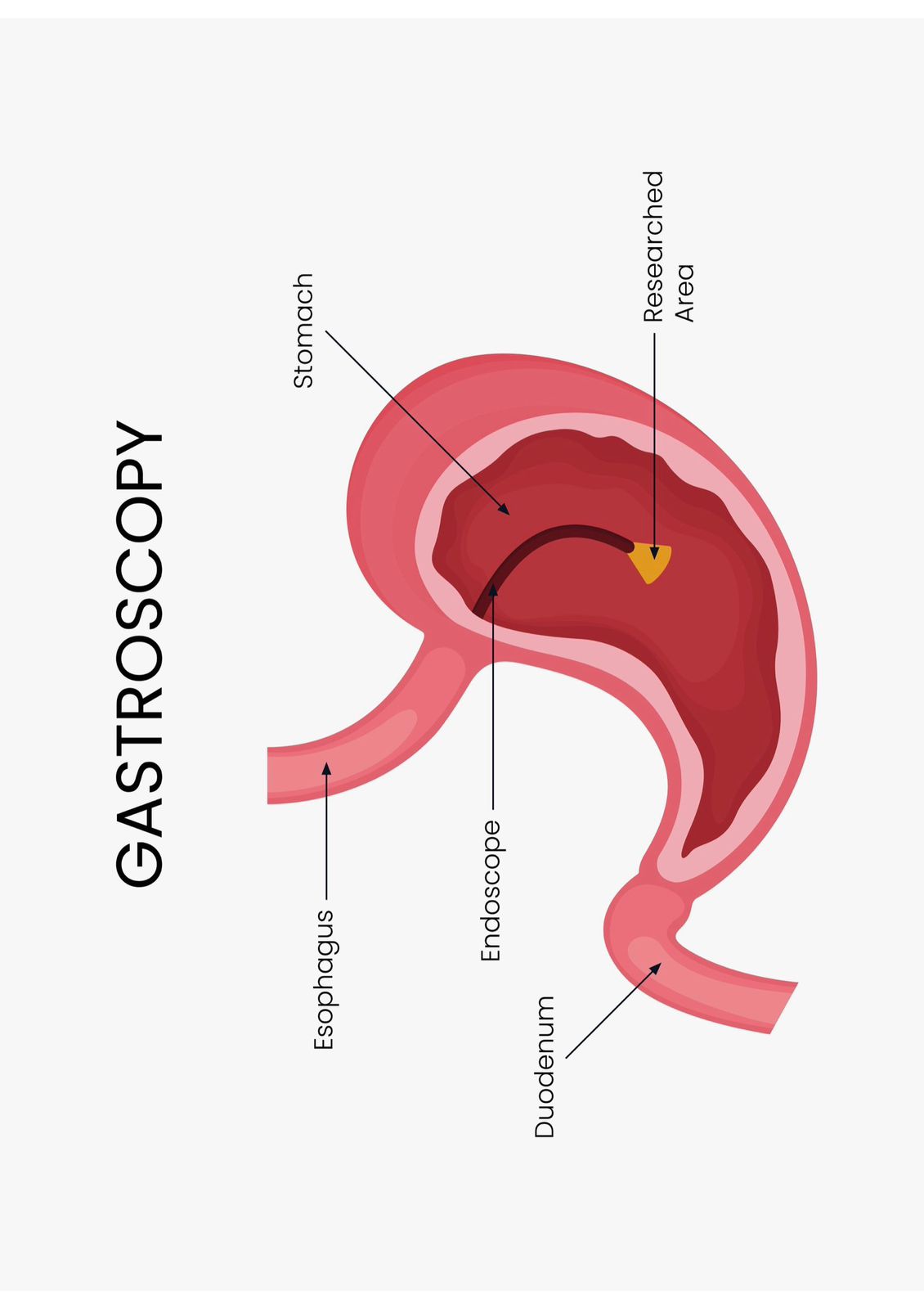 Gastroscopy procedure illustration